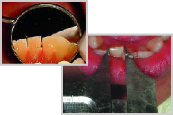 歯の幅の調整の画像